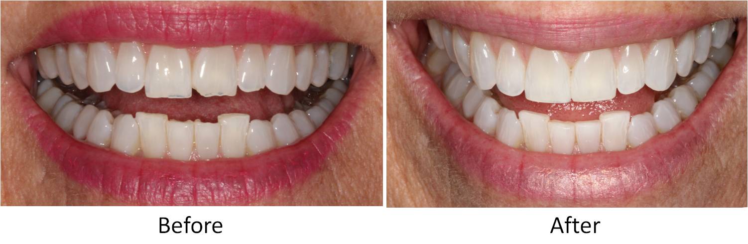 One-stop Bonding Downtown Dallas Tx Dallas Dental Arts One-stop Bonding Downtown Dallas Tx Dallas Dental Arts