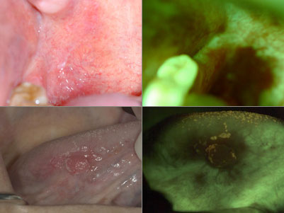 photo of mucosal abnormality