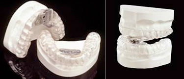 photo of teeth molds
